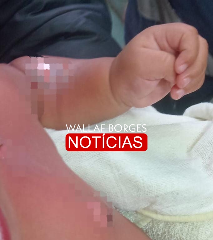 Bebê de 9 meses sofre queimaduras graves durante banho em CMEI de Sarandi e passa por cirurgia no HU de Maringá