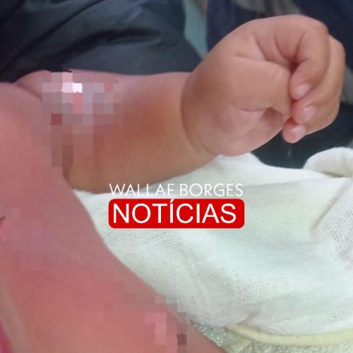 Bebê de 9 meses sofre queimaduras graves durante banho em CMEI de Sarandi e passa por cirurgia no HU de Maringá