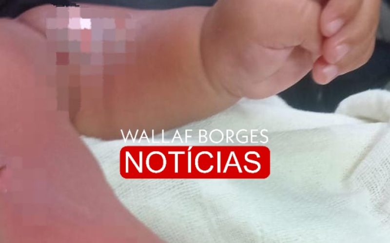 Bebê de 9 meses sofre queimaduras graves durante banho em CMEI de Sarandi e passa por cirurgia no HU de Maringá